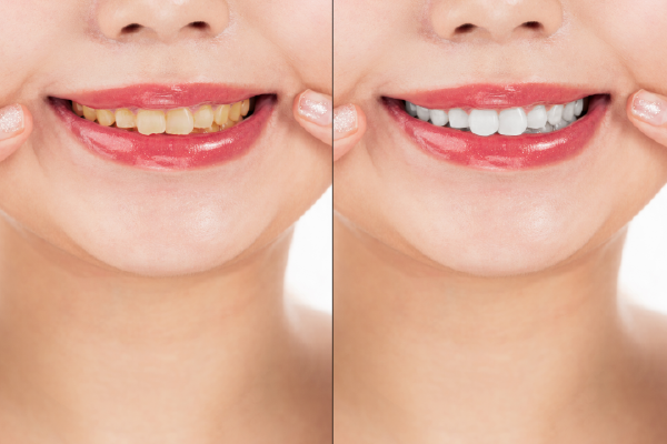 歯にとってよくないこと